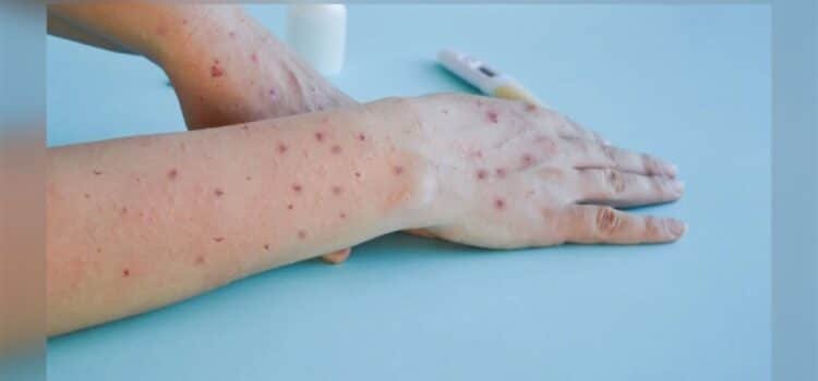 Seis casos nuevos de viruela símica en Yucatán, alerta sanitaria