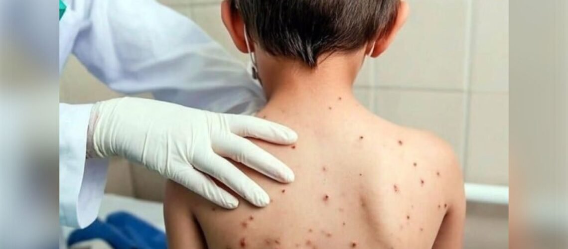 Yucatán alerta ante brote de sarampión