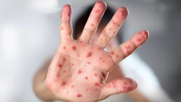 Yucatán refuerza vigilancia sanitaria ante 11 casos de sarampión