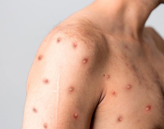 Yucatán suma 18 casos de mpox y se mantiene entre los estados con mayor incidencia